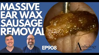 MASSIVE EAR WAX SAUSAGE REMOVED FROM PATIENTS EAR  EP908 [upl. by Tteirrah]