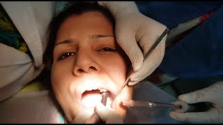 Dental Drilling  Root Canal  Dent Economy  Dentist  Dental [upl. by Enohpesrep]