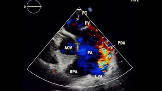 Patent ductus arteriosus to drahmadmirdamadisiomBJXyOSRxfgQGe5 [upl. by Senecal267]