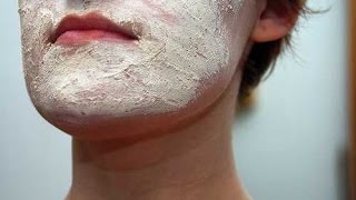 Face Eczema  Atopic Dermatitis  Eczema Dermatitis Rash Treatment [upl. by Ahsinauj777]