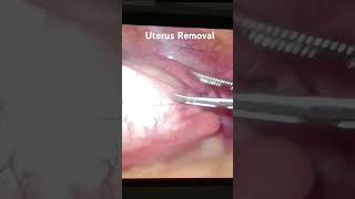 Uterus of RemovalLaparoscopic hysterectomy viral public short video 🙏💕🙏🙏💕 [upl. by Nolrev]