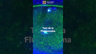 Test de la Fluoresceína en la Queratitis Punctata Superficial [upl. by Mendive]