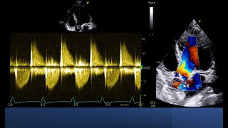 Color doppler is not enough to assess Severity of aortic Regurgitation [upl. by Vonnie768]