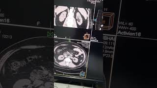 CT SCAN Abdomen SCAN [upl. by Gaughan]