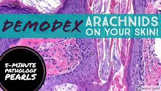 Demodex Tiny Arachnids living on your skin [upl. by Aerdnaxela38]