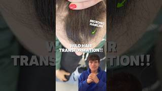 INSANE 3 MONTH HAIR REGROWTH viral shorts [upl. by Valene]