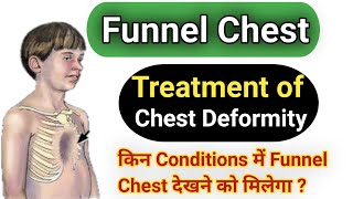 Funnel Chest  Pectus exacavatum  Funnel Chest Treatment in Hindi [upl. by Brewer632]