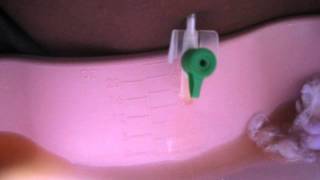 Drainage of Ascites using abdominal paracentesis [upl. by Ahsenhoj391]