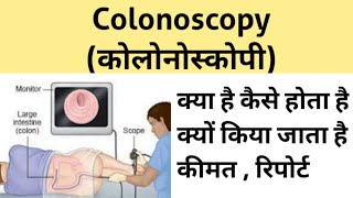 Colonoscopy test in Hindi  कोलोनोस्कोपी टेस्ट क्या है  कैसे होता है [upl. by Artnoed543]