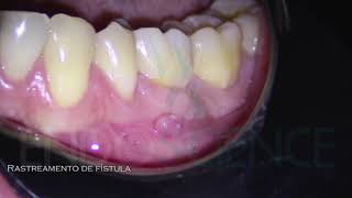 ABSCESSO PERIAPICAL COM FÍSTULA [upl. by Ingaborg]