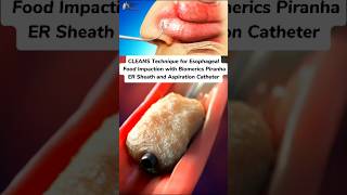 CLEANS Technique for Esophageal Food Impaction medical animation 3d short [upl. by Addiego262]