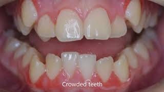 Fix crooked teeth and crossbite with braces [upl. by Williamson]