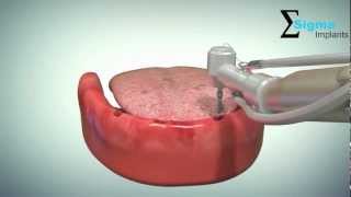 Implant supported overdenture rehabilitation [upl. by Anneh]