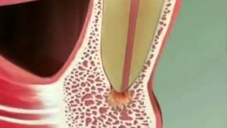 Jacksonville FL Endodontist Shares Video Animation of Root Canal Apicoectomy [upl. by Laen426]