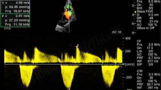 Stenosi polmonare canePulmonic stenosisCardiologia Veterinariaeuwmv [upl. by Edras]