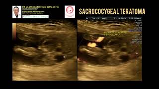 Fetus in Fetu Parasitic Twins Sacrococcygeal Teratoma [upl. by Ydak748]