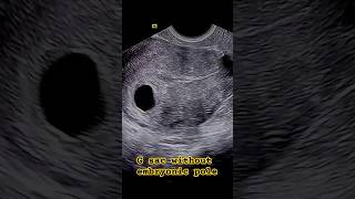 Gestational sac without yolk sac or embryonic node [upl. by Acinnej6]