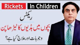 Rickets Disease  Causes amp Treatment  Rickets In Children  By Dr Khalid Jamil [upl. by Lihp]