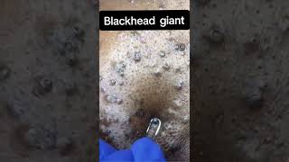 giantblackheads blackheadsremoval blackheads blackheadsremovalmask extracaodecravos bigblackhe [upl. by Emelin849]