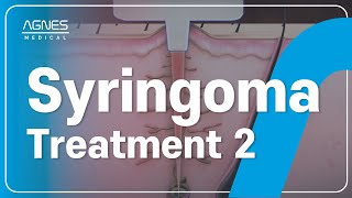 AGNES  Treatment Syringoma Treatment 2 ⚡️✨ [upl. by Kimberly]