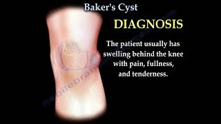 Bakers Cyst of the kneemeniscus tear arthritis of the knee [upl. by Gerrard542]