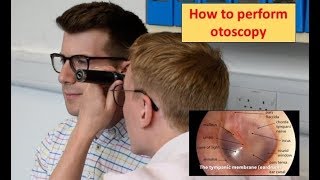 How to perform Otoscopy Ear Exam [upl. by Ruosnam]