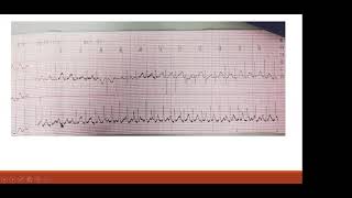 atrial tachycardia EP study and ablation Dr Lamyaa Allam [upl. by Leunamnauj]