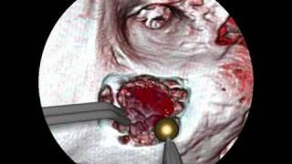 Enhancing Realism of Wet Surfaces in Temporal Bone Surgical Simulation [upl. by Nosnibor225]