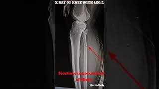 Fracture of fibula  Radiology shortvideo [upl. by Loram]