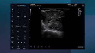 Ultrasound guided Axillary brachial plexus nerve block [upl. by Elleiram]