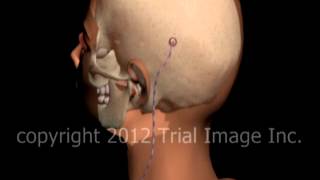 Hydrocephalus shunt video by Dr Cal Shipley MD [upl. by Ermentrude]