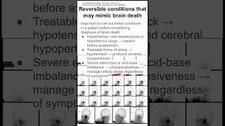 Reversible conditions that may mimic brain death [upl. by Simpson37]