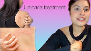 How I cured my chronic urticaria hives treatment hives urticaria ayurvedic sheetpit [upl. by Nolasba]