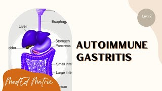 Autoimmune gastritis  Pathogenesis  Morphology  Clinical features [upl. by Roseline]