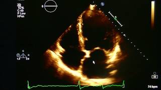 Echocardiogram With Atrial Fibrillation Practice Visual Estimation Ejection Fraction [upl. by Afrikah]