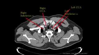 Major Thoracic Vessels  Arteries [upl. by Kelly674]