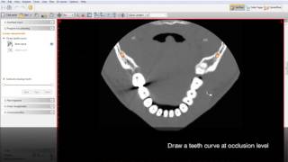 SimPlant 15 Virtual Teeth Design [upl. by Townie]