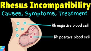 Rhesus Incompatibility  Rh Incompatibility in Pregnancy – Causes Symptoms Diagnosis amp Treatments [upl. by Lednew]