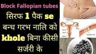 fellopian tube blockage in hindi  fellopian tube blockage treatment heenhaealth [upl. by Marchal584]