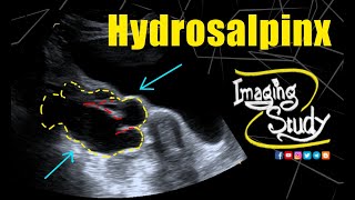 Hydrosalpinx  Ultrasound  Case 329 [upl. by Seditsira407]