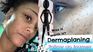 Skin Scraping follow up Dermaplaning Facial [upl. by Yddur]