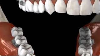 Braces Overjet [upl. by Arvind]