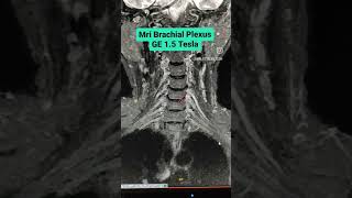 MRI Brachial Plexus on GE 15 Tesla viral mri shorts [upl. by Ellasal]