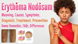 Erythema Nodosum meaning causes symptoms diagnosis treatment prevention home remedies FAQs [upl. by Brittne415]