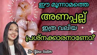 മൂന്നാമത്തെ അണപ്പല്ല്🦷Remove your wisdom teeth if you have these problems wisdomtoothpain dentist [upl. by Haidej]