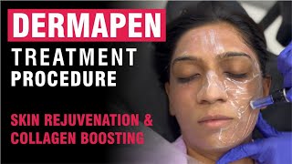 Dermapen Treatment Procedure  Skin Rejuvenation amp Collagen Boosting [upl. by Tenenbaum956]