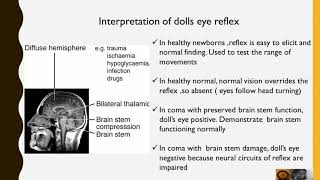 Dolls eye Reflex [upl. by Eimmot]