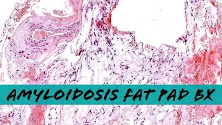 Systemic Amyloidosis on abdominal fat pad biopsy with Congo red stain pathology dermatopathology [upl. by Anidem466]