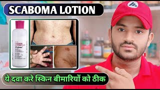 Scaboma lotion uses dose benefits and Side effects full review in hindi [upl. by Ohaus]