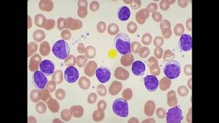 Pathology  dr Nafea  Acute lymphoblastic leukemia ALL أورام [upl. by Ihtraa495]